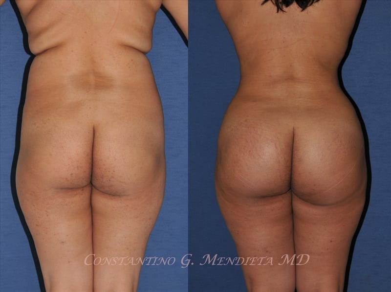 Fat Transfer & Brazilian Butt Lift before-and-after photo — 4Beauty Aesthetic Institute