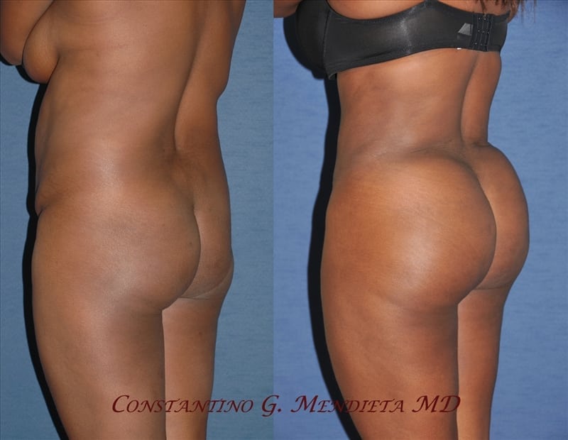 Fat Transfer & Brazilian Butt Lift before-and-after photo — 4Beauty Aesthetic Institute