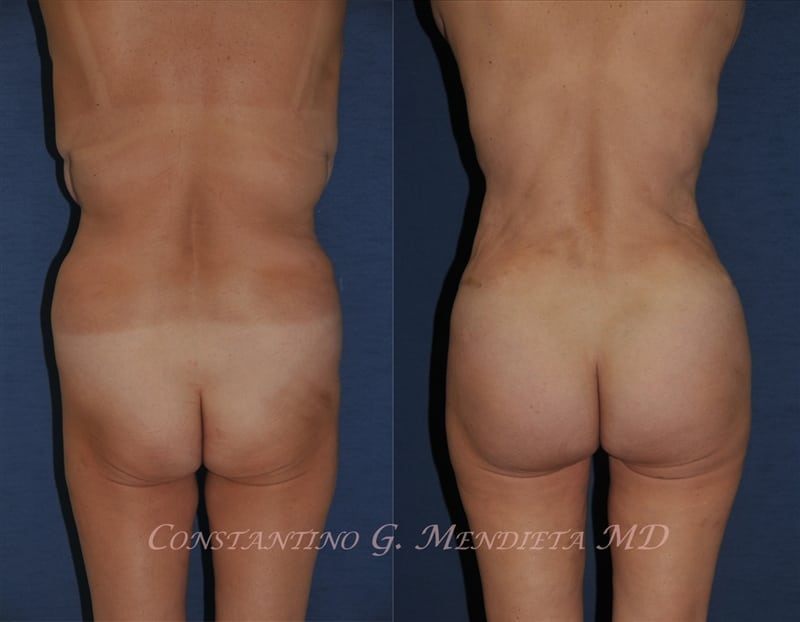 Fat Transfer & Brazilian Butt Lift before-and-after photo — 4Beauty Aesthetic Institute
