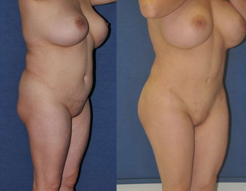 Fat Transfer & Brazilian Butt Lift before-and-after photo — 4Beauty Aesthetic Institute
