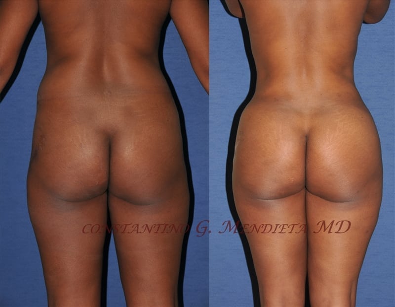 Fat Transfer & Brazilian Butt Lift before-and-after photo — 4Beauty Aesthetic Institute