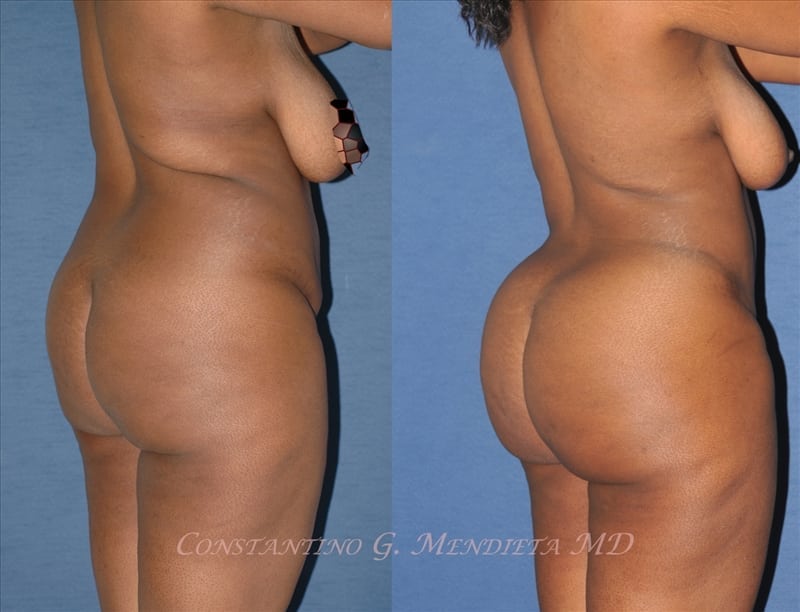 Fat Transfer & Brazilian Butt Lift before-and-after photo — 4Beauty Aesthetic Institute