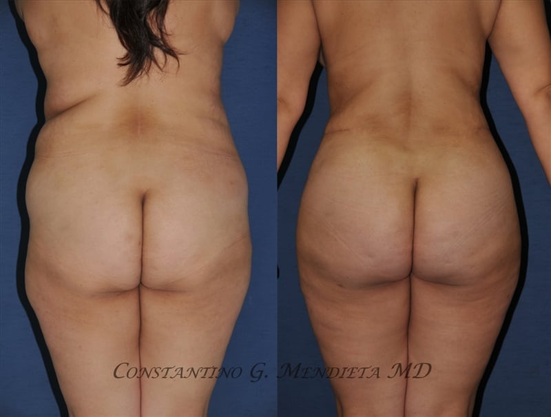 Fat Transfer & Brazilian Butt Lift before-and-after photo — 4Beauty Aesthetic Institute