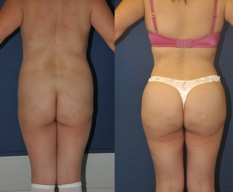 Fat Transfer & Brazilian Butt Lift before-and-after photo — 4Beauty Aesthetic Institute