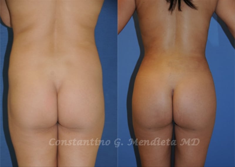 Fat Transfer & Brazilian Butt Lift before-and-after photo — 4Beauty Aesthetic Institute