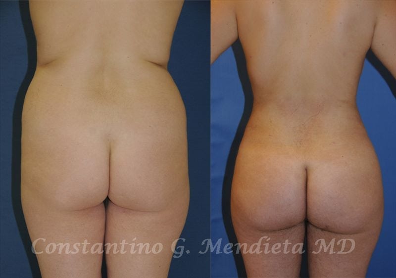 Fat Transfer & Brazilian Butt Lift before-and-after photo — 4Beauty Aesthetic Institute