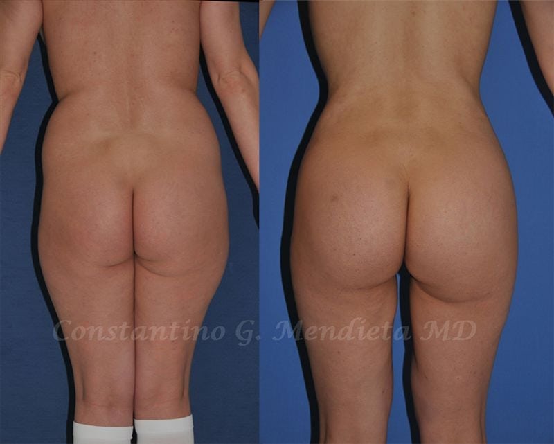 Fat Transfer & Brazilian Butt Lift before-and-after photo — 4Beauty Aesthetic Institute