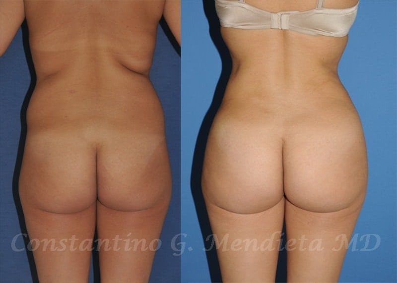 Fat Transfer & Brazilian Butt Lift before-and-after photo — 4Beauty Aesthetic Institute