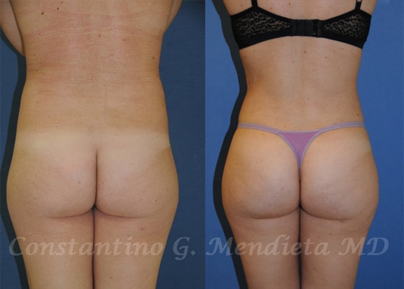 Fat Transfer & Brazilian Butt Lift before-and-after photo — 4Beauty Aesthetic Institute