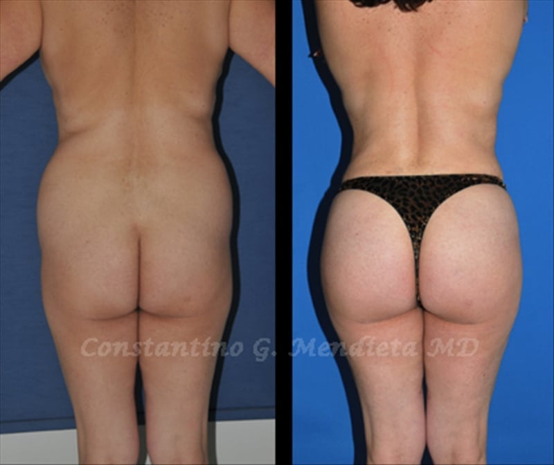 Fat Transfer & Brazilian Butt Lift before-and-after photo — 4Beauty Aesthetic Institute