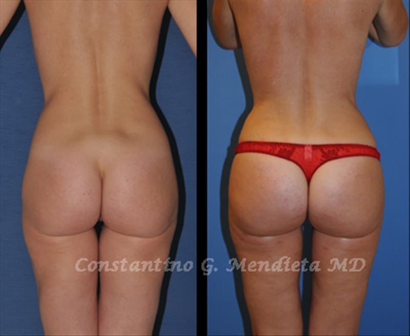 Fat Transfer & Brazilian Butt Lift before-and-after photo — 4Beauty Aesthetic Institute