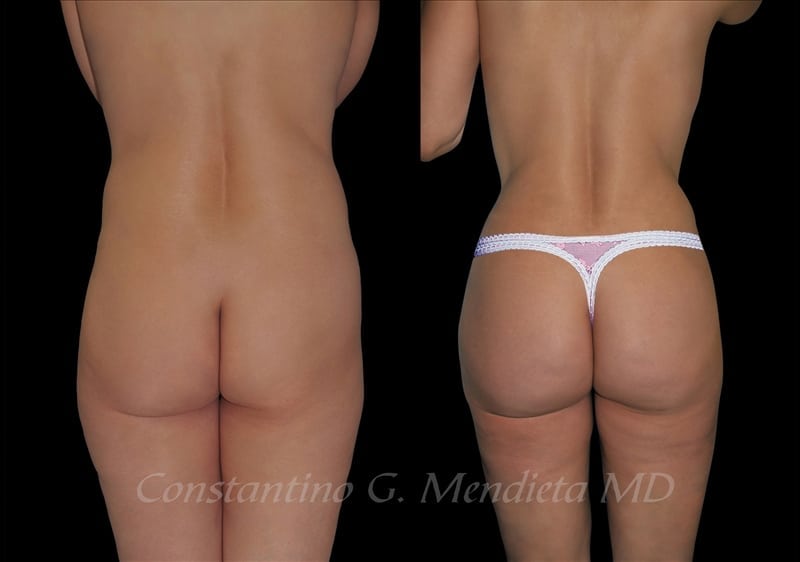 Fat Transfer & Brazilian Butt Lift before-and-after photo — 4Beauty Aesthetic Institute
