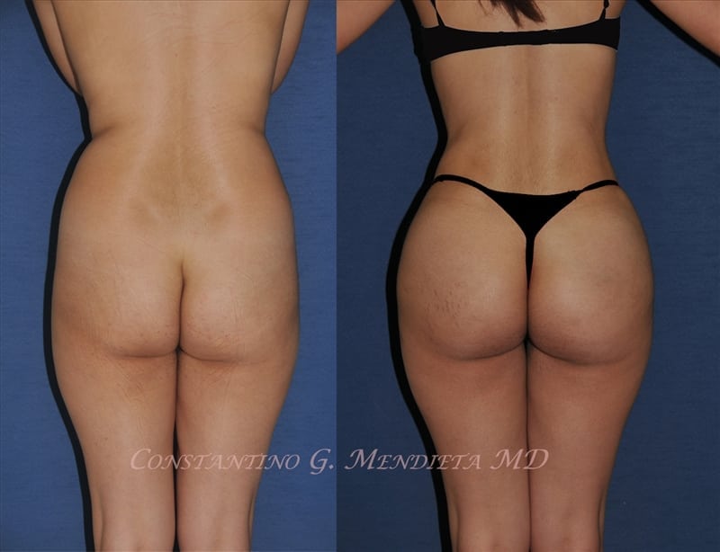 Fat Transfer & Brazilian Butt Lift before-and-after photo — 4Beauty Aesthetic Institute