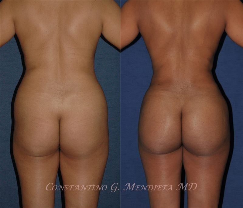 Fat Transfer & Brazilian Butt Lift before-and-after photo — 4Beauty Aesthetic Institute