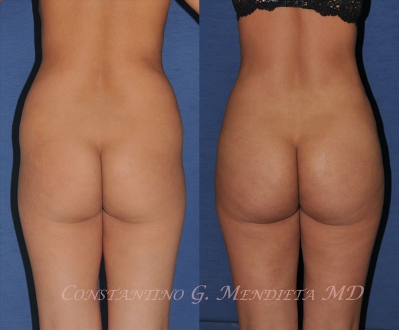 Fat Transfer & Brazilian Butt Lift before-and-after photo — 4Beauty Aesthetic Institute