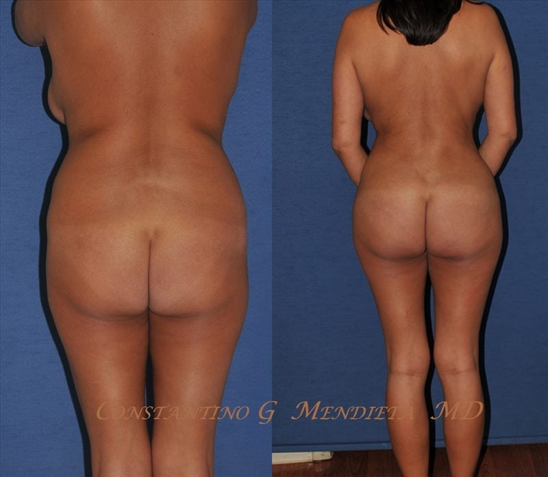 Fat Transfer & Brazilian Butt Lift before-and-after photo — 4Beauty Aesthetic Institute
