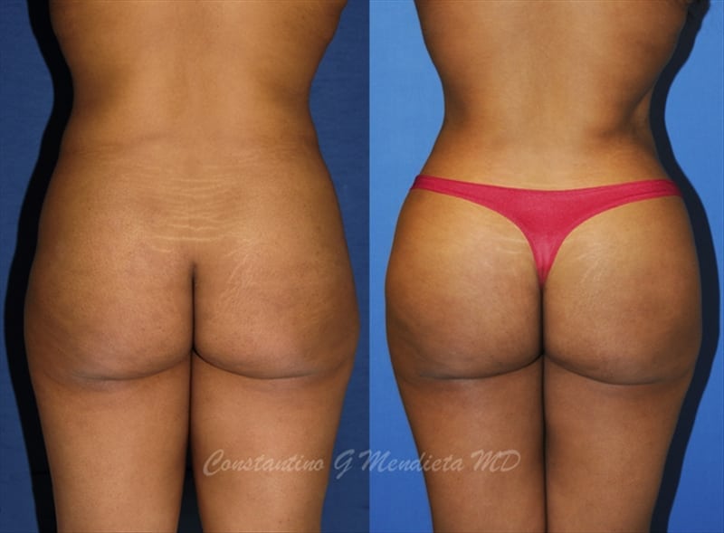 Fat Transfer & Brazilian Butt Lift before-and-after photo — 4Beauty Aesthetic Institute