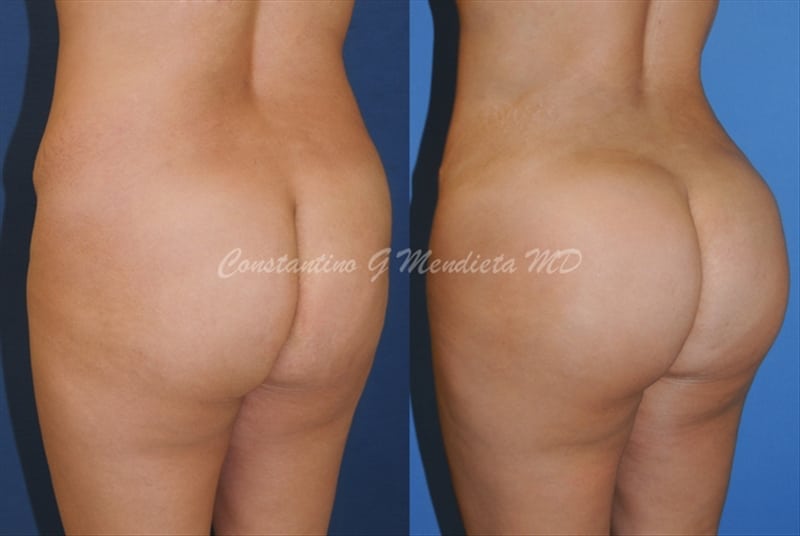 Fat Transfer & Brazilian Butt Lift before-and-after photo — 4Beauty Aesthetic Institute