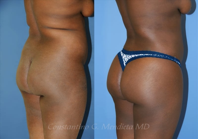 Fat Transfer & Brazilian Butt Lift before-and-after photo — 4Beauty Aesthetic Institute