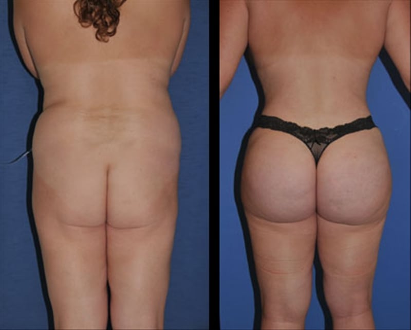 Fat Transfer & Brazilian Butt Lift before-and-after photo — 4Beauty Aesthetic Institute
