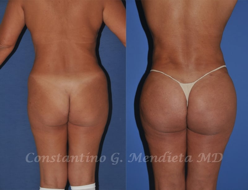Fat Transfer & Brazilian Butt Lift before-and-after photo — 4Beauty Aesthetic Institute
