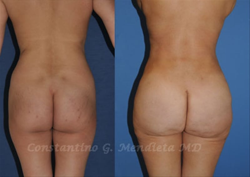 Fat Transfer & Brazilian Butt Lift before-and-after photo — 4Beauty Aesthetic Institute
