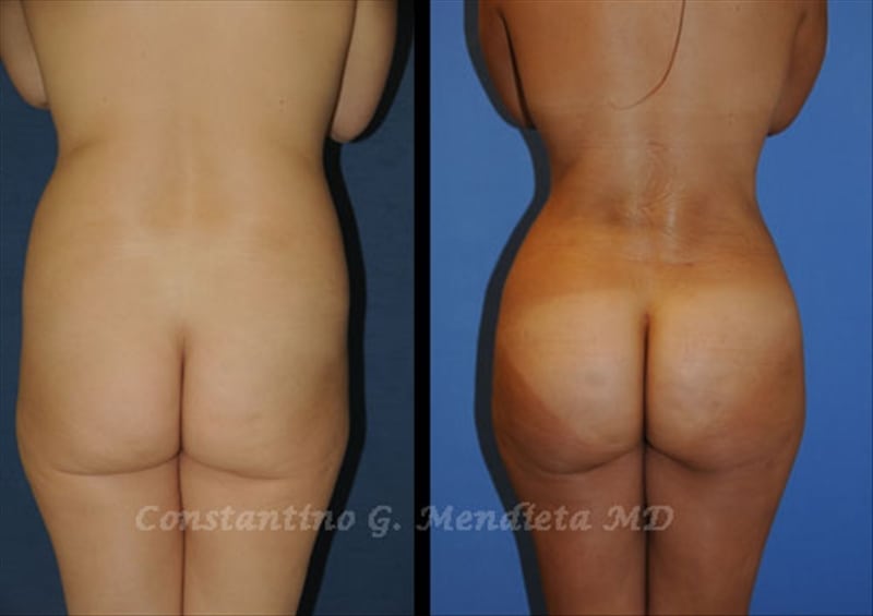 Fat Transfer & Brazilian Butt Lift before-and-after photo — 4Beauty Aesthetic Institute