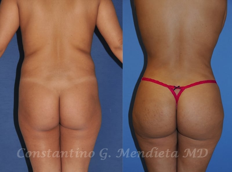 Fat Transfer & Brazilian Butt Lift before-and-after photo — 4Beauty Aesthetic Institute