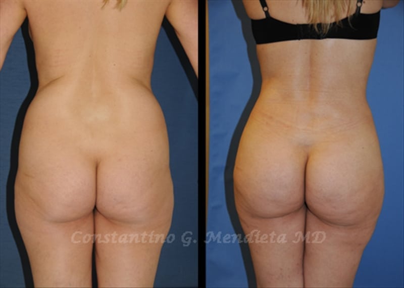 Fat Transfer & Brazilian Butt Lift before-and-after photo — 4Beauty Aesthetic Institute