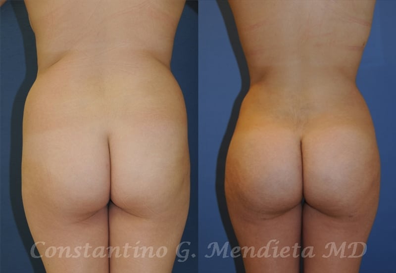 Fat Transfer & Brazilian Butt Lift before-and-after photo — 4Beauty Aesthetic Institute