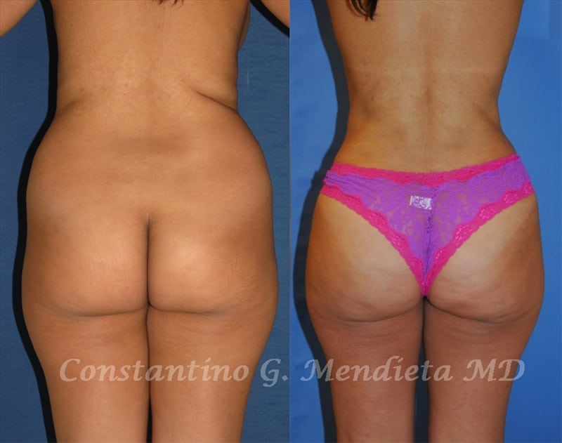 Fat Transfer & Brazilian Butt Lift before-and-after photo — 4Beauty Aesthetic Institute