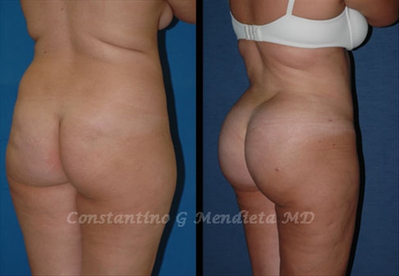 Fat Transfer & Brazilian Butt Lift before-and-after photo — 4Beauty Aesthetic Institute