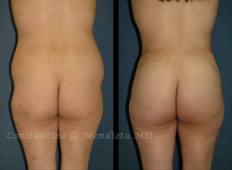 Fat Transfer & Brazilian Butt Lift before-and-after photo — 4Beauty Aesthetic Institute