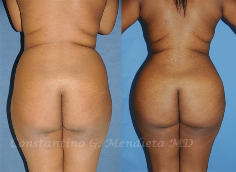 Fat Transfer & Brazilian Butt Lift before-and-after photo — 4Beauty Aesthetic Institute
