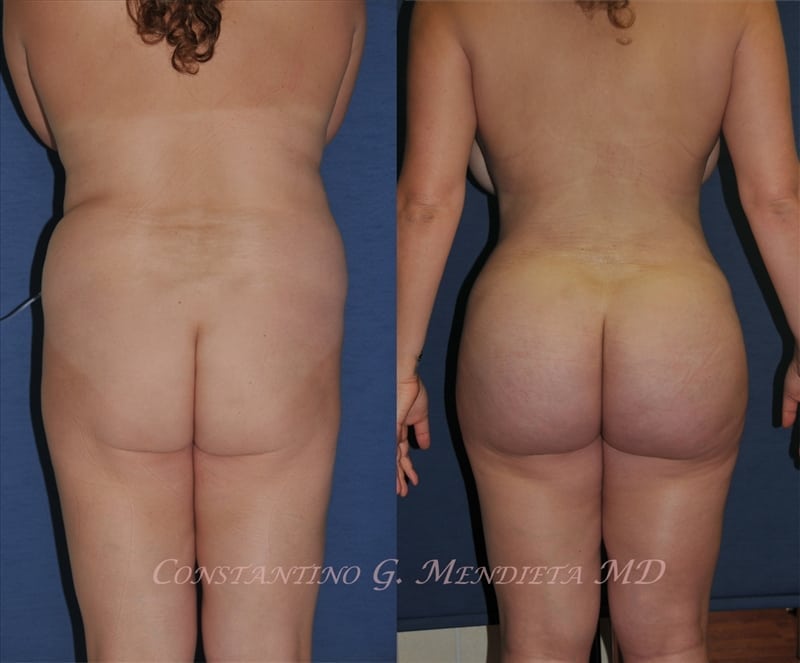 Fat Transfer & Brazilian Butt Lift before-and-after photo — 4Beauty Aesthetic Institute
