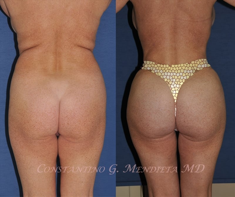 Fat Transfer & Brazilian Butt Lift before-and-after photo — 4Beauty Aesthetic Institute