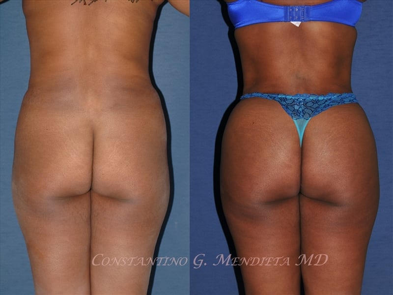Fat Transfer & Brazilian Butt Lift before-and-after photo — 4Beauty Aesthetic Institute