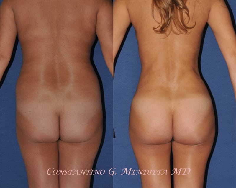 Fat Transfer & Brazilian Butt Lift before-and-after photo — 4Beauty Aesthetic Institute
