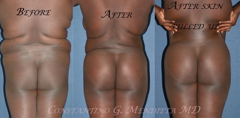 Fat Transfer & Brazilian Butt Lift before-and-after photo — 4Beauty Aesthetic Institute