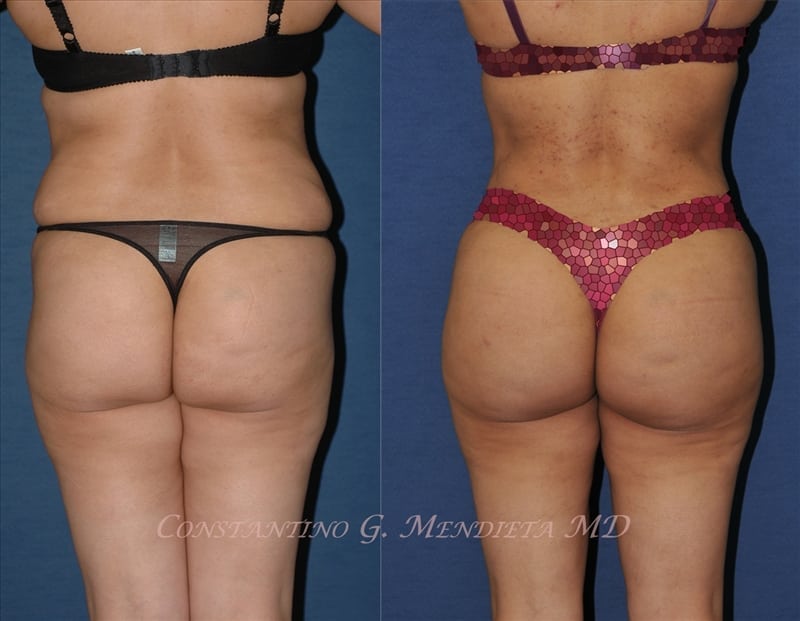 Fat Transfer & Brazilian Butt Lift before-and-after photo — 4Beauty Aesthetic Institute