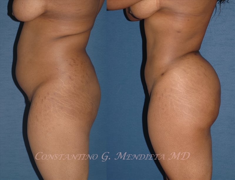 Fat Transfer & Brazilian Butt Lift before-and-after photo — 4Beauty Aesthetic Institute