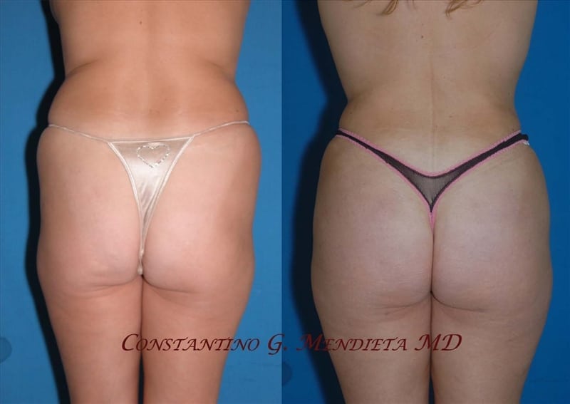 Fat Transfer & Brazilian Butt Lift before-and-after photo — 4Beauty Aesthetic Institute