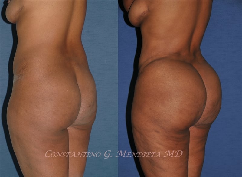 Fat Transfer & Brazilian Butt Lift before-and-after photo — 4Beauty Aesthetic Institute
