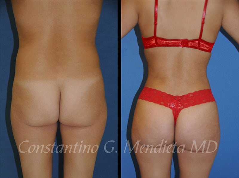 Fat Transfer & Brazilian Butt Lift before-and-after photo — 4Beauty Aesthetic Institute