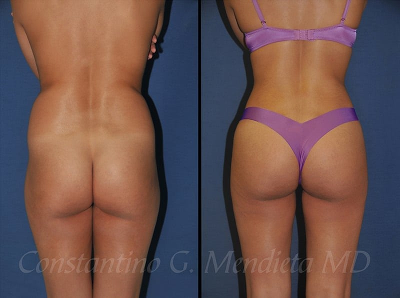 Fat Transfer & Brazilian Butt Lift before-and-after photo — 4Beauty Aesthetic Institute