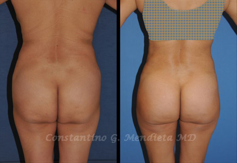 Fat Transfer & Brazilian Butt Lift before-and-after photo — 4Beauty Aesthetic Institute
