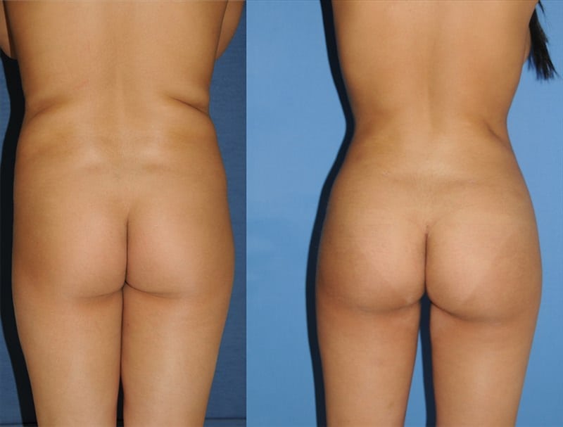 Fat Transfer & Brazilian Butt Lift before-and-after photo — 4Beauty Aesthetic Institute