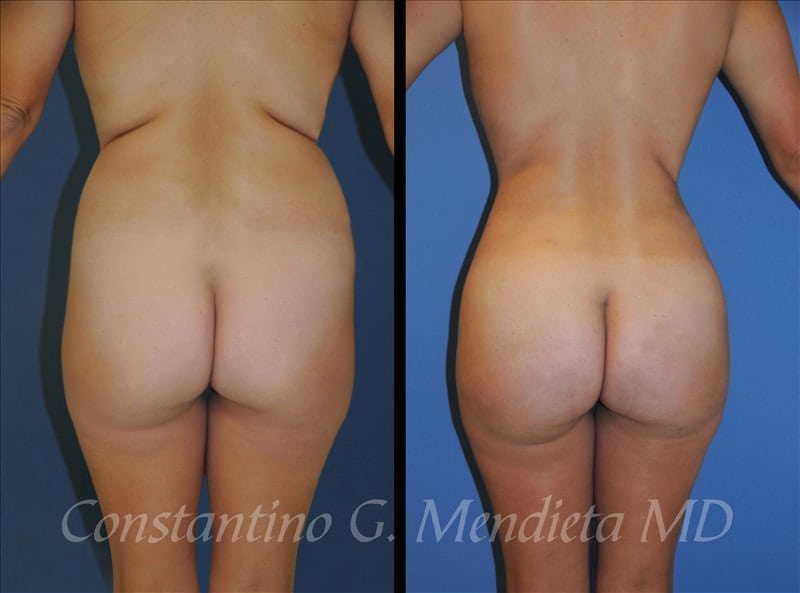 Fat Transfer & Brazilian Butt Lift before-and-after photo — 4Beauty Aesthetic Institute