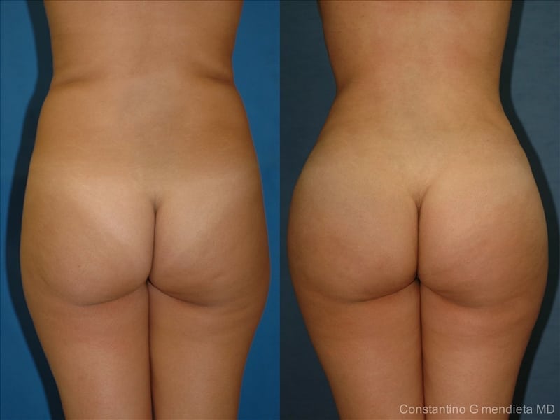 Fat Transfer & Brazilian Butt Lift before-and-after photo — 4Beauty Aesthetic Institute