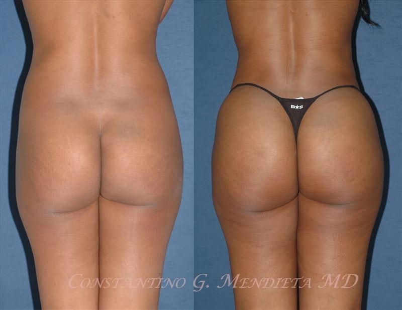 Fat Transfer & Brazilian Butt Lift before-and-after photo — 4Beauty Aesthetic Institute